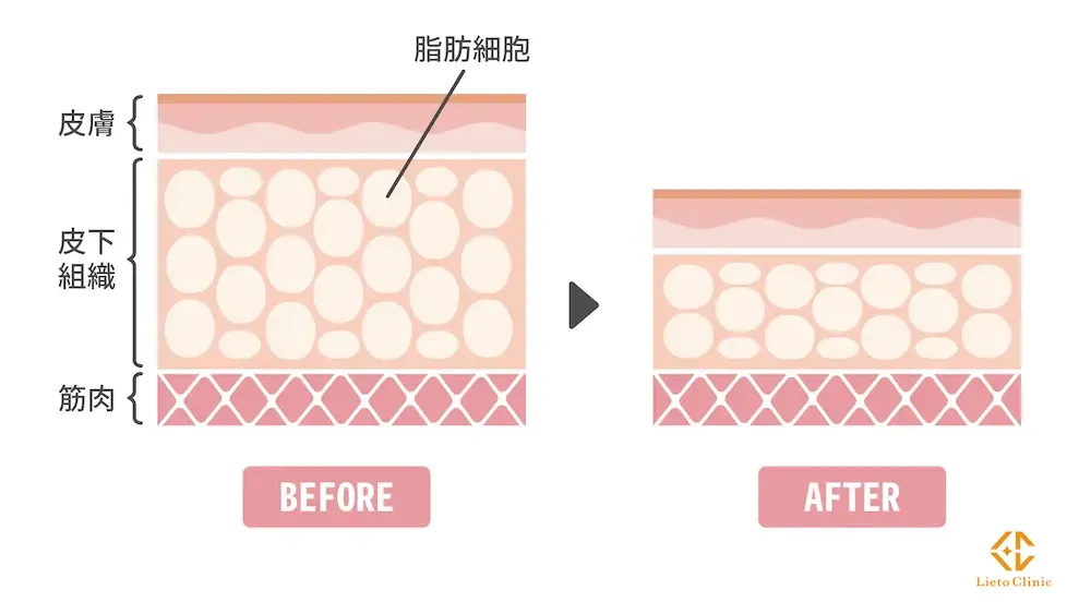 脂肪細胞の数が減ることを表す図解