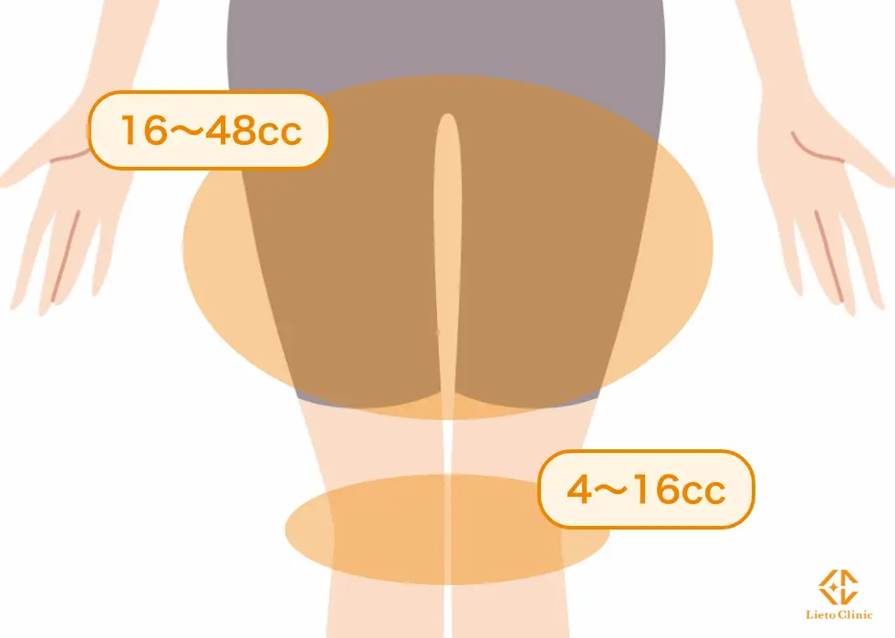 太ももの脂肪溶解注射注入量の目安