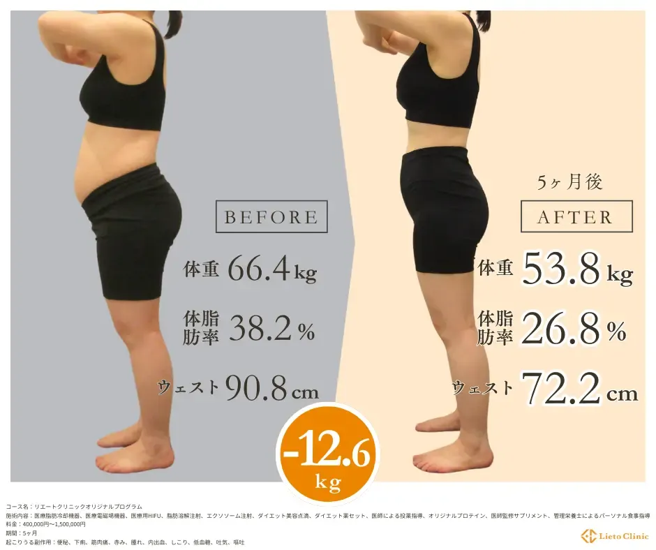 症例：50代女性 / -12.6kg / 154cm