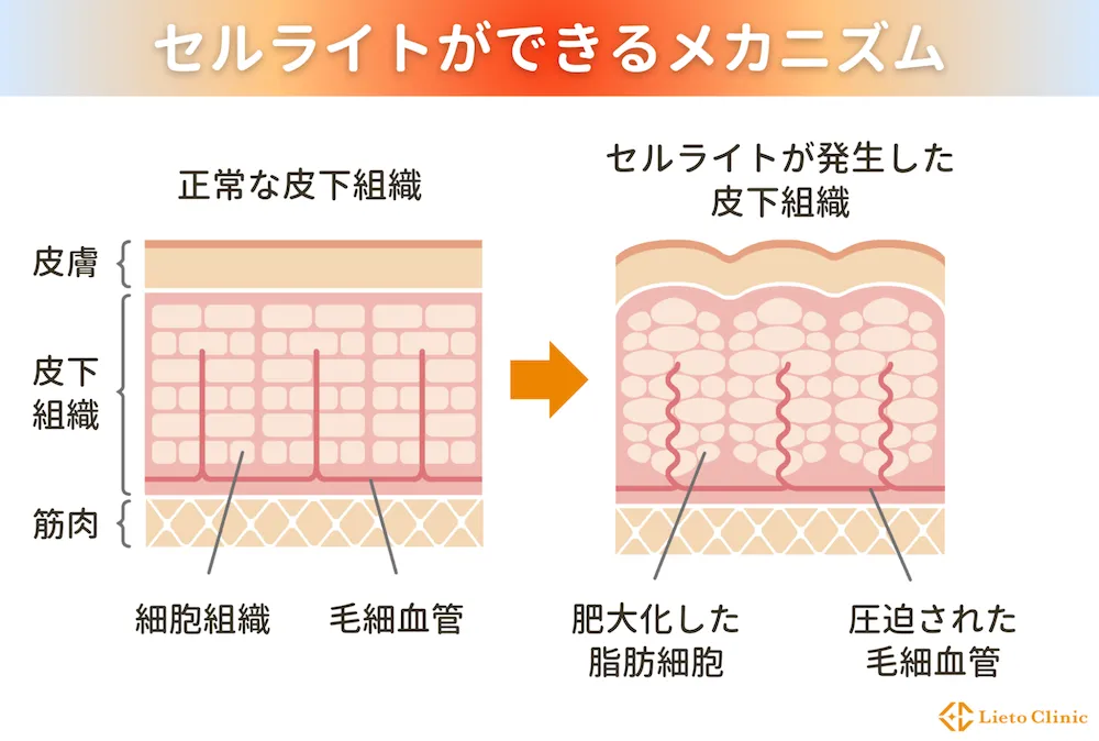 セルライトができるメカニズム