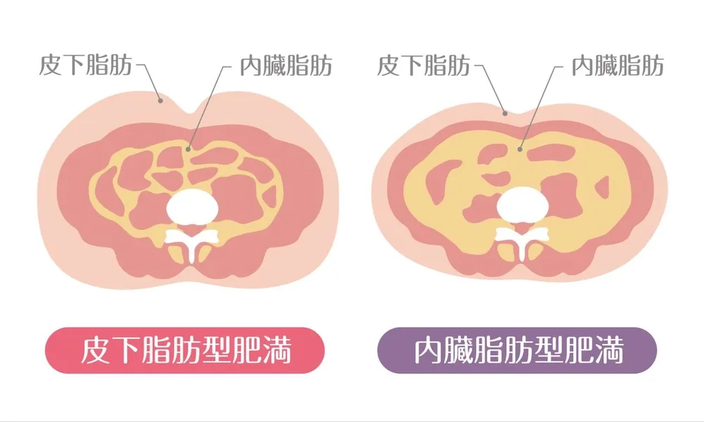 皮下脂肪型肥満と内臓脂肪型肥満のイラスト