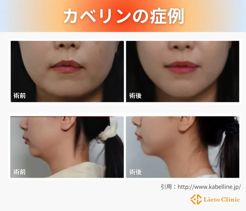 カベリンの症例